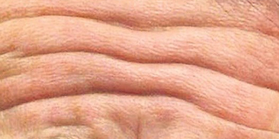 Wrinkle02