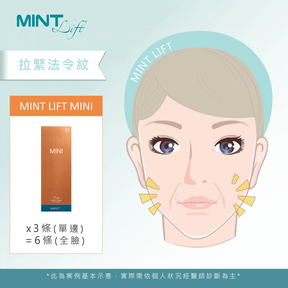 Mintlift 02b