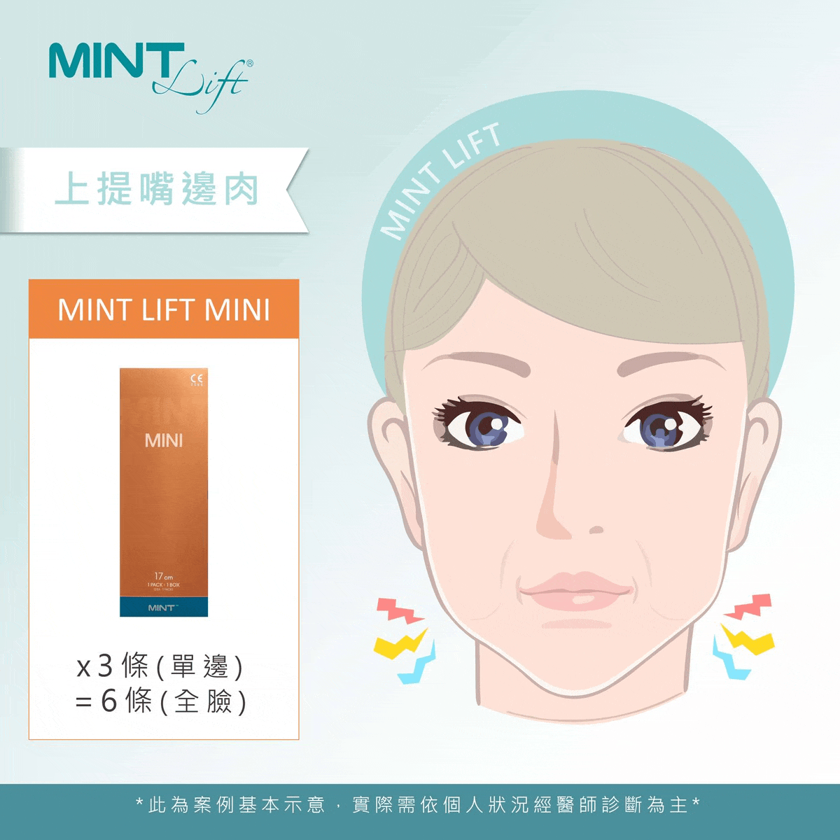 Mintlift 02c