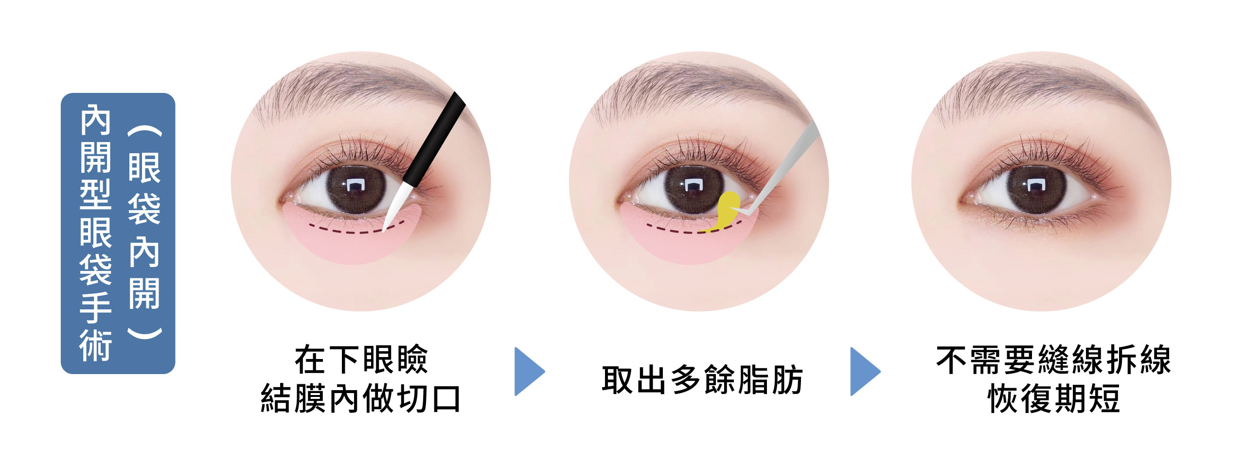 Eye bags 01