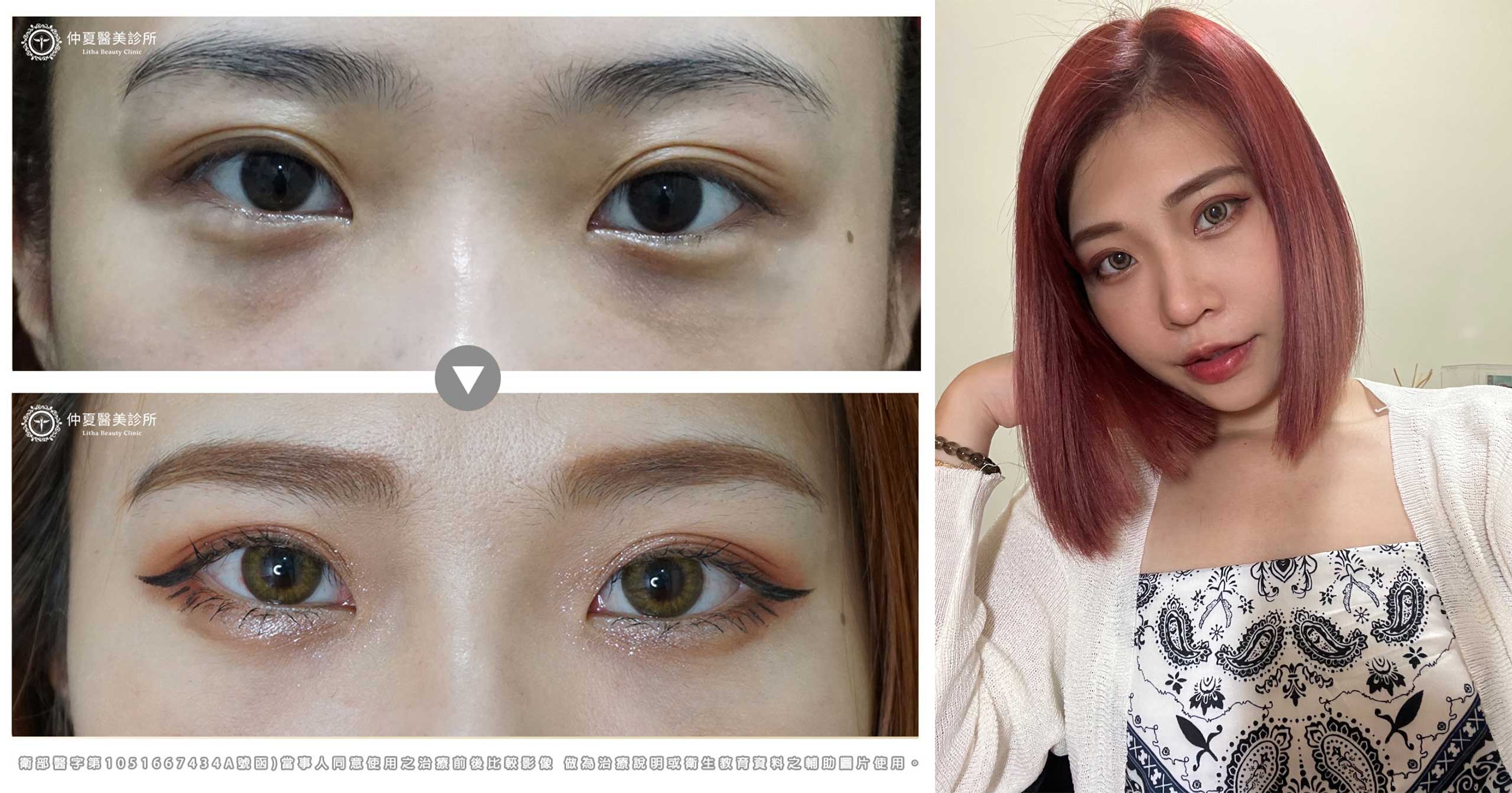 Eye bags 2022 ba