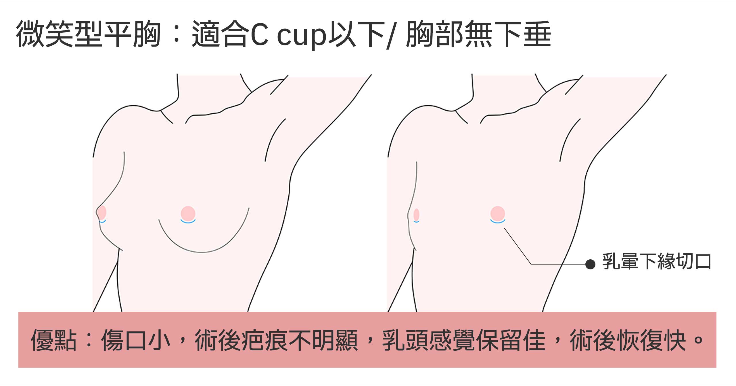 Flat chest surgery 01