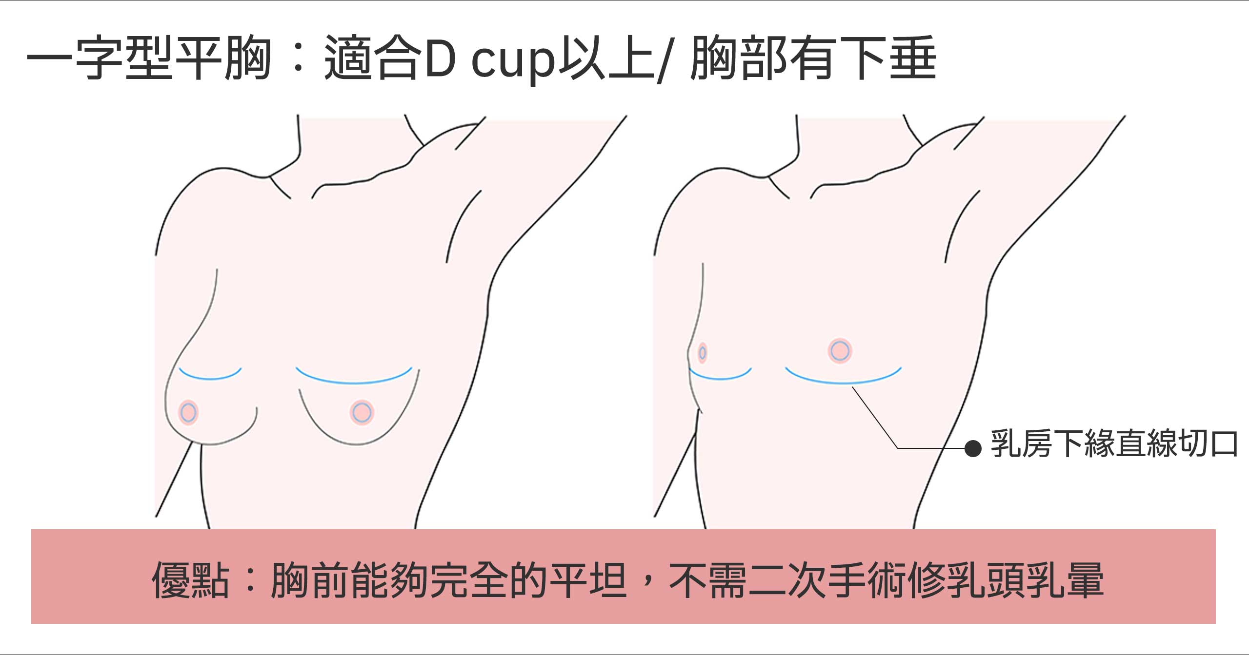 Flat chest surgery 02