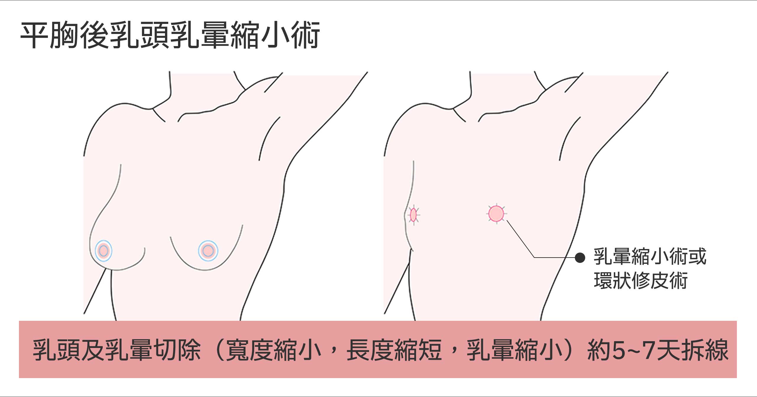 Flat chest surgery 03