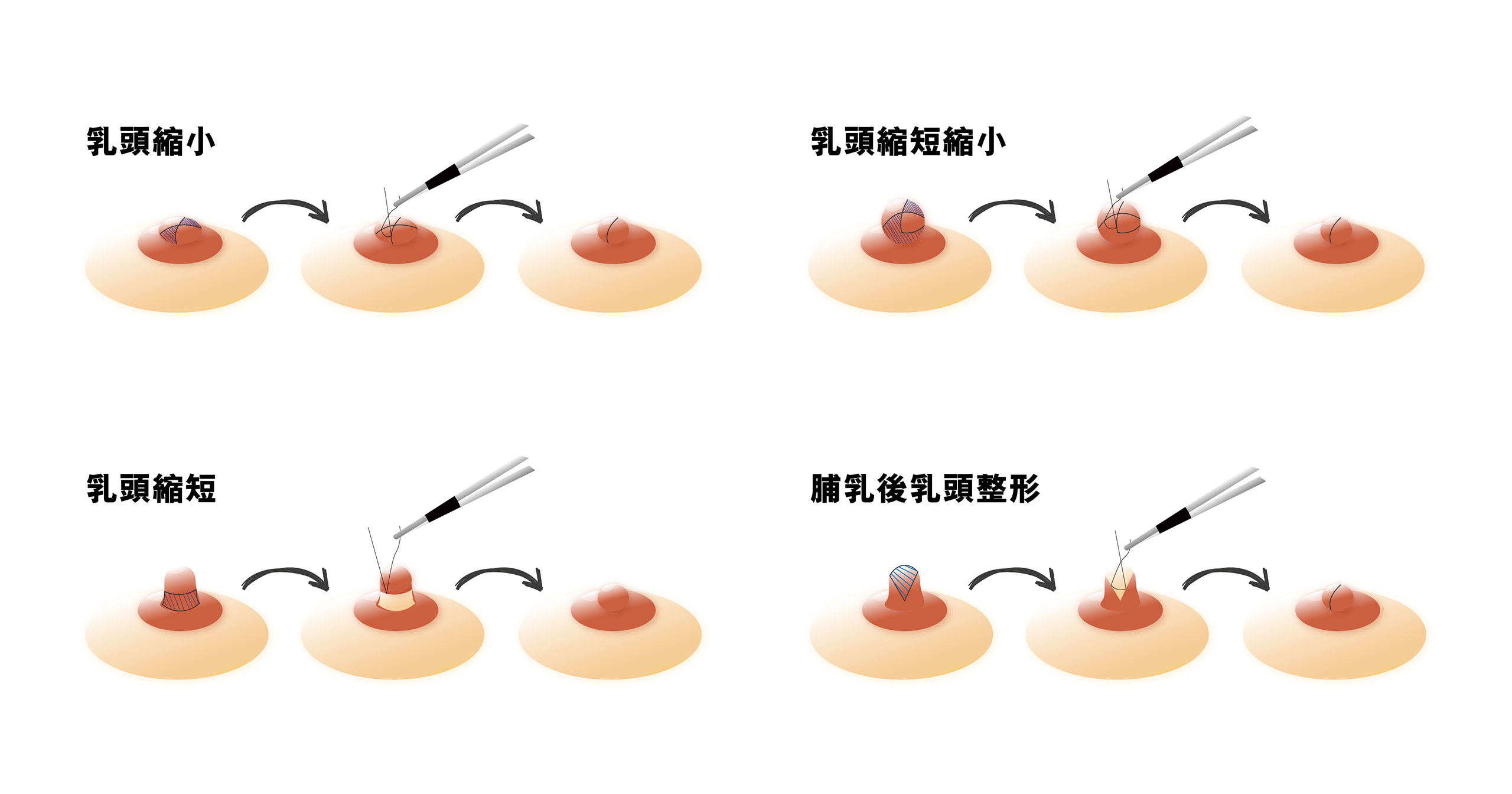 Flat chest surgery 04