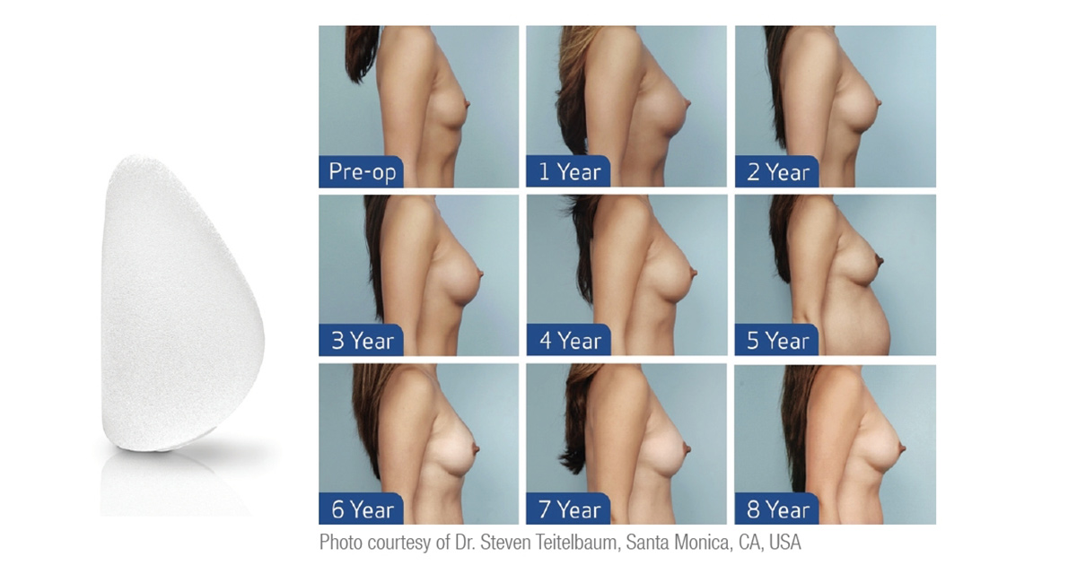 Mentorbreast 09