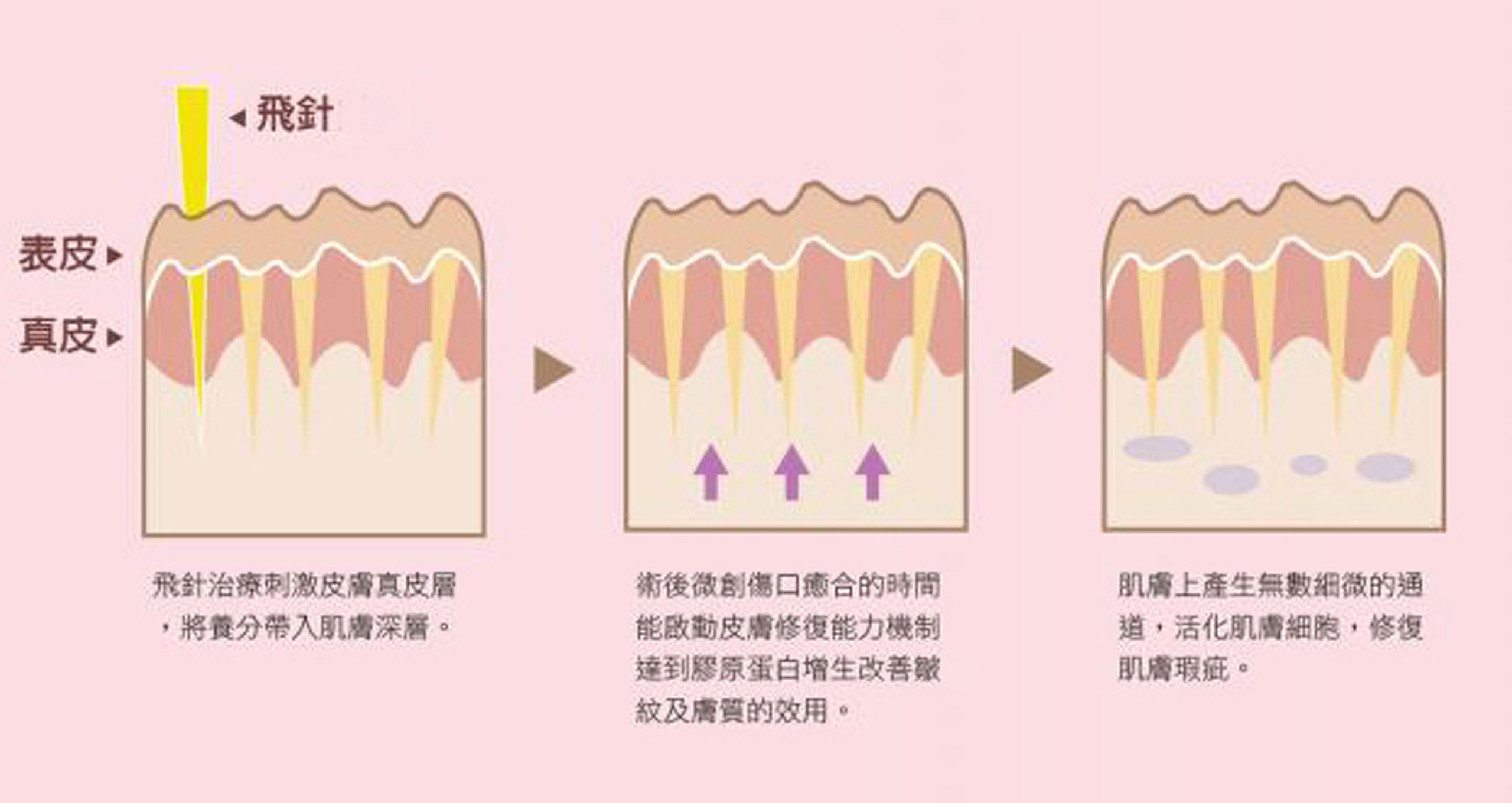 Abscess needle 01